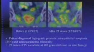 Interaction of IVC with Chemotherapeutic Agents